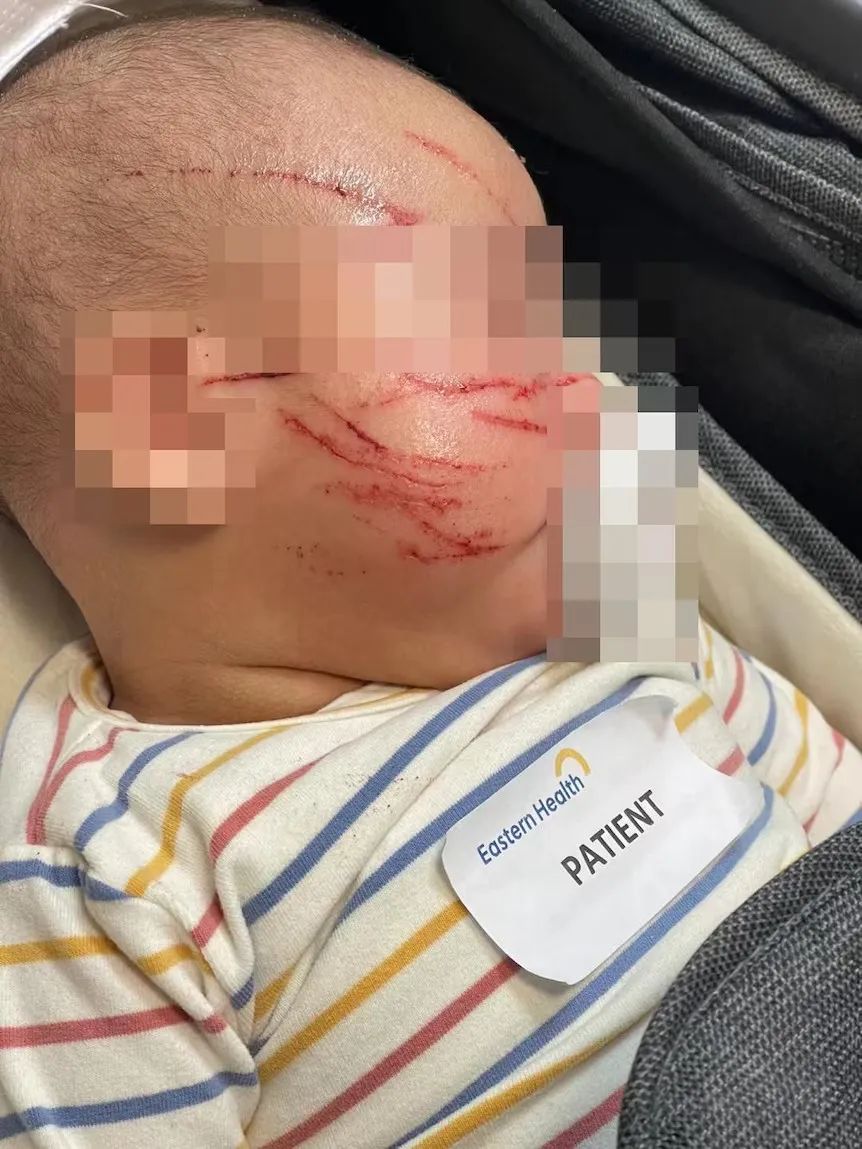 墨尔本10周宝宝被攻击事件续：孩子在托儿所受伤，专家告诉你应该怎样做